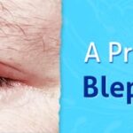 A-Primer-on-Blepharitis-Childrens-Eye-Center-OC