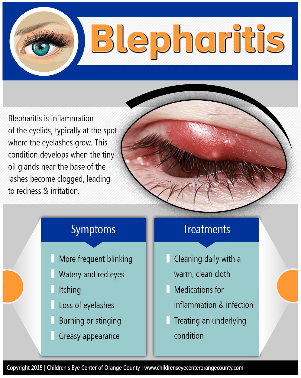 Blepharitis-by-Childrens-Eye-Center
