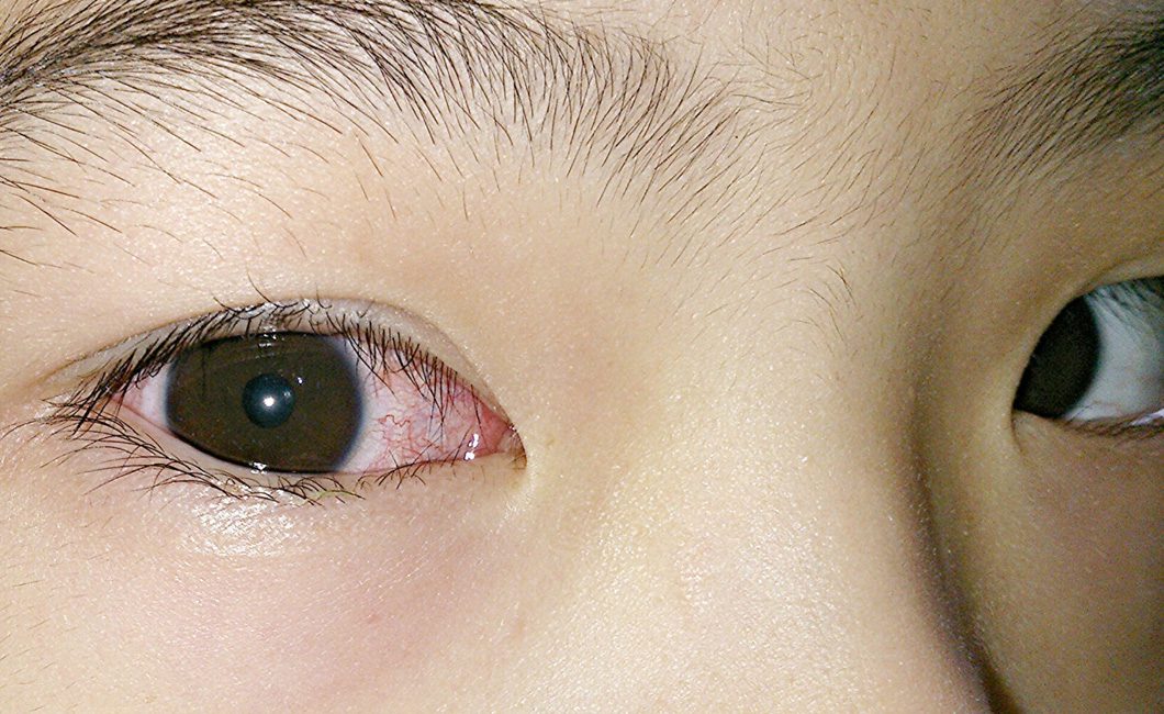 Eye-Infection-Treatment-for-Kids