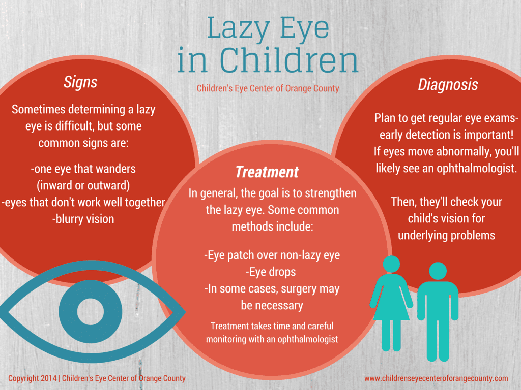 Lazy-Eye-in-Children-by-Childrens-Eye-Center-of-Orange-County